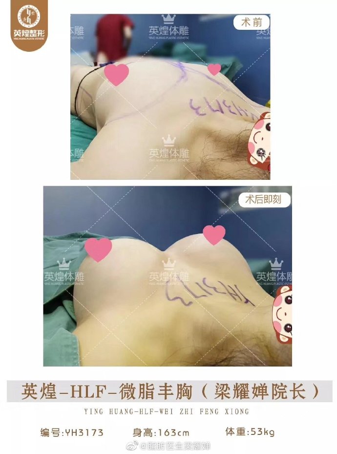 梁耀婵脂肪丰胸案例